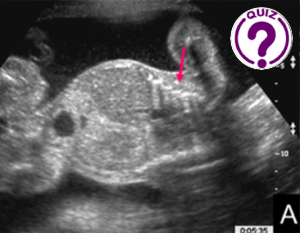 Case of the Month May 2024 - A not-so-routine antenatal ultrasound