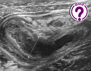 Case of the month January 2025: Girl with abdominal pain